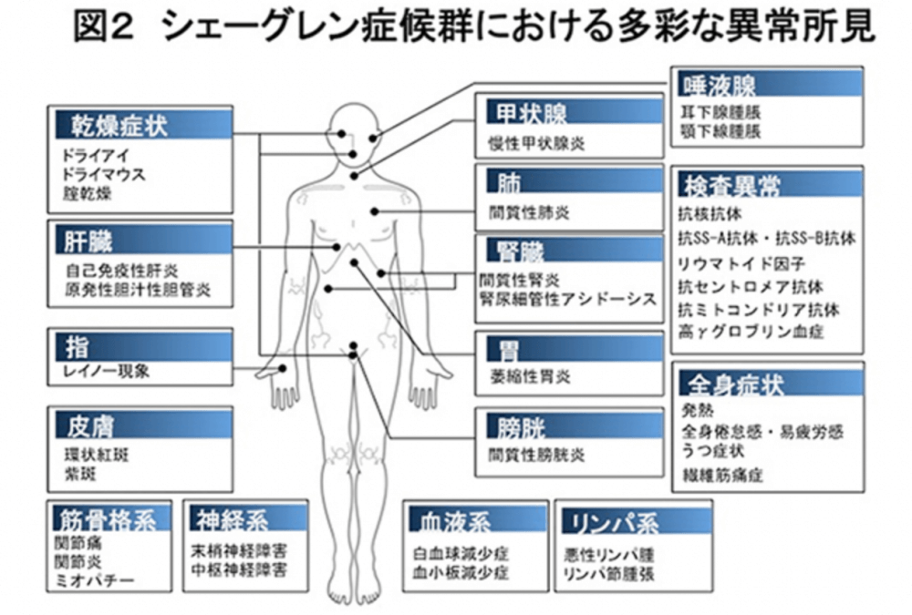 シェーグレン症候群　症状